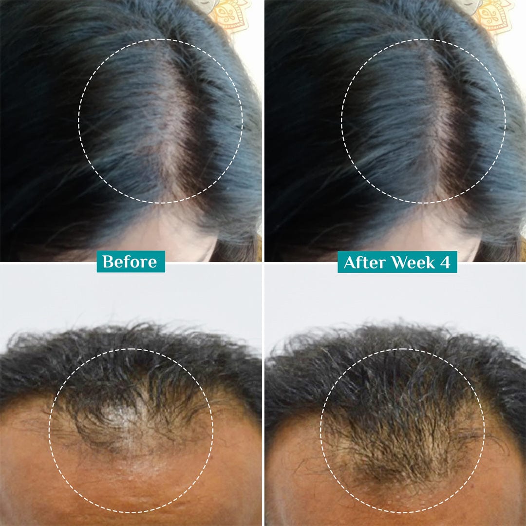 hair loss treatment