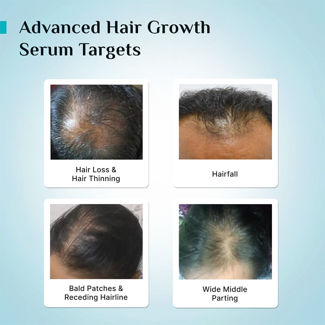 hair loss treatment